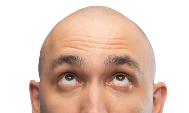 Calling a man ‘bald’ is sex harassment, employment tribunal rules